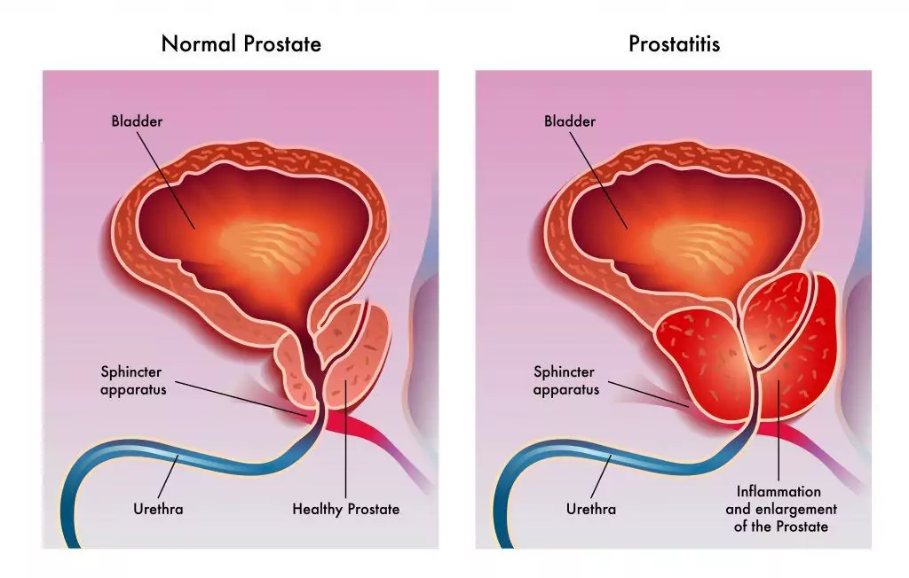 próstata inflamada