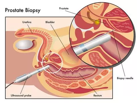 Biopsia de próstata ante la sospecha de cáncer