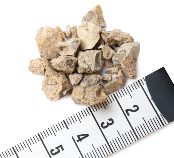 analisis-calculo-renal